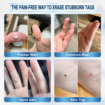 𝐇𝐈𝐒𝐊𝐈𝐍®👩‍⚕️ 7-Day Wart & Skin Tag Remover Rollerball Pen ✨ Maximum Strength Precision Care for Common Warts, Plantar Warts & Skin Imperfections | Easy At-Home Treatment