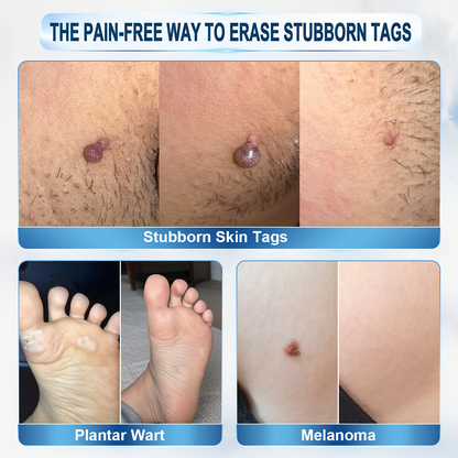 𝐇𝐈𝐒𝐊𝐈𝐍®👩‍⚕️ 7-Day Wart & Skin Tag Remover Rollerball Pen ✨ Maximum Strength Precision Care for Common Warts, Plantar Warts & Skin Imperfections | Easy At-Home Treatment