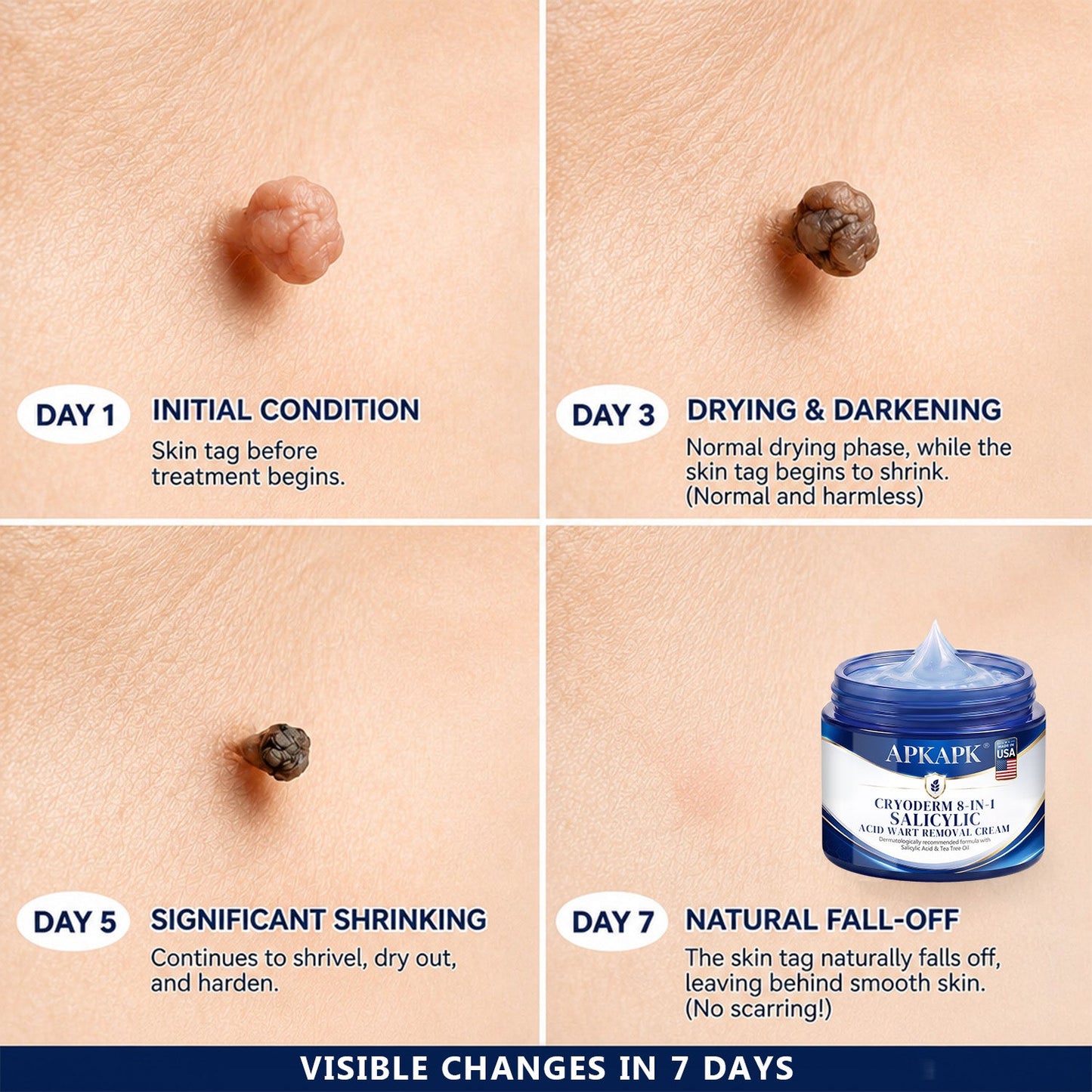 APKAPK® CryoDerm 8-in-1 Salicylic Acid Wart Removal Cream (Pain-Free Formula – No Scars)🎉