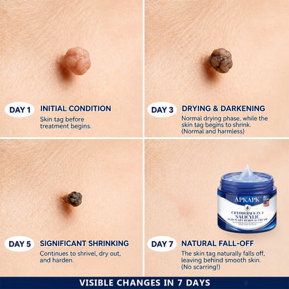 APKAPK® CryoDerm 8-in-1 Salicylic Acid Wart Removal Cream (Pain-Free Formula – No Scars)🎉